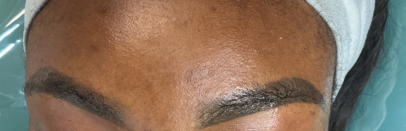Eyebrow tattoo removal after one session on melanated skin in Atlanta, lightened brow pigment