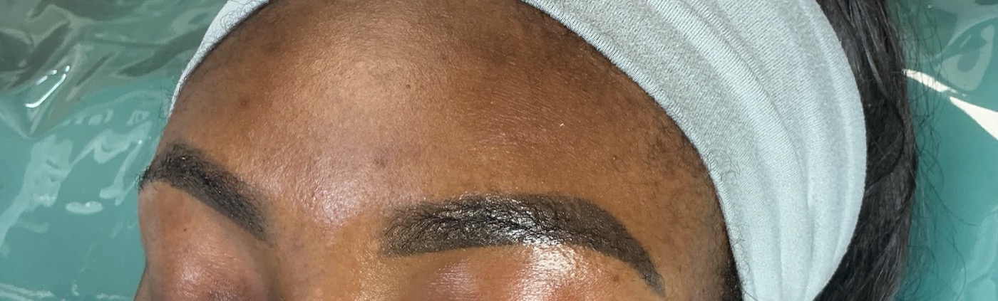 Eyebrow tattoo removal before on melanated skin in Atlanta, dark saturated permanent makeup brows