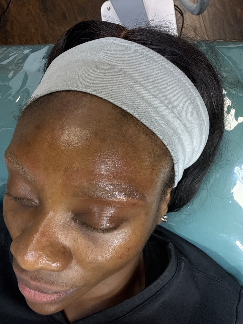 Eyebrow tattoo pigment visibly faded after one removal session on dark skin in Atlanta, GA